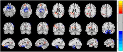 Regional homogeneity alterations of resting-state functional magnetic resonance imaging of chronic rhinosinusitis with olfactory dysfunction